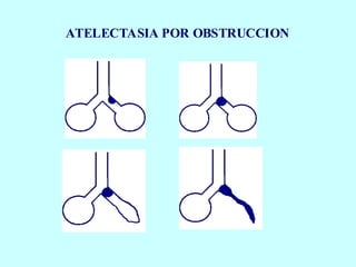 ATELECTASIA POR OBSTRUCCION
 