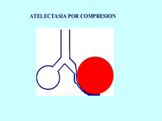 ATELECTASIA POR COMPRESION
 