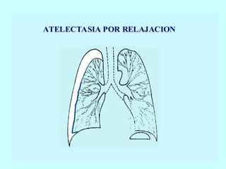 ATELECTASIA POR RELAJACION
 