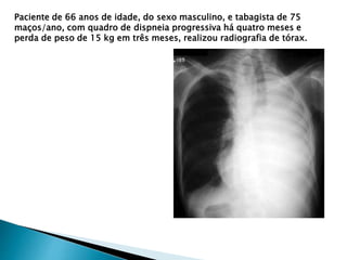 Paciente de 66 anos de idade, do sexo masculino, e tabagista de 75
maços/ano, com quadro de dispneia progressiva há quatro meses e
perda de peso de 15 kg em três meses, realizou radiografia de tórax.
 