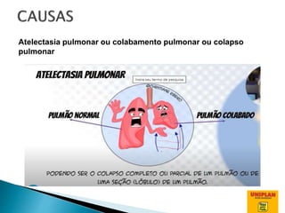 Atelectasia pulmonar ou colabamento pulmonar ou colapso
pulmonar
 