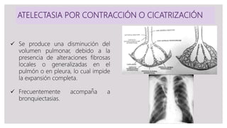 ATELECTASIA POR CONTRACCIÓN O CICATRIZACIÓN
 Se produce una disminución del
volumen pulmonar, debido a la
presencia de alteraciones fibrosas
locales o generalizadas en el
pulmón o en pleura, lo cual impide
la expansión completa.
 Frecuentemente acompaña a
bronquiectasias.
 
