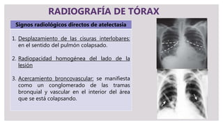 RADIOGRAFÍA DE TÓRAX
Signos radiológicos directos de atelectasia
1. Desplazamiento de las cisuras interlobares:
en el sentido del pulmón colapsado.
2. Radiopacidad homogénea del lado de la
lesión
3. Acercamiento broncovascular: se manifiesta
como un conglomerado de las tramas
bronquial y vascular en el interior del área
que se está colapsando.
 