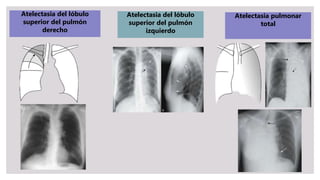 Atelectasia del lóbulo
superior del pulmón
derecho
Atelectasia del lóbulo
superior del pulmón
izquierdo
Atelectasia pulmonar
total
 