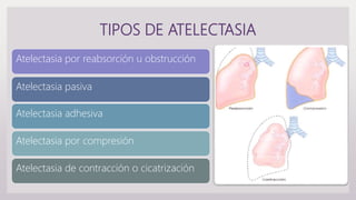 TIPOS DE ATELECTASIA
Atelectasia por reabsorción u obstrucción
Atelectasia pasiva
Atelectasia adhesiva
Atelectasia por compresión
Atelectasia de contracción o cicatrización
 