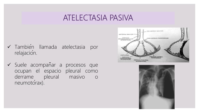 Atelectasia | PPT
