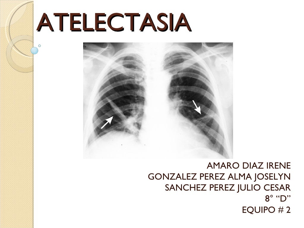 Atelectasia