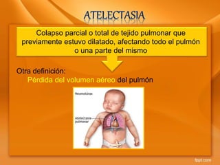 Colapso parcial o total de tejido pulmonar que
previamente estuvo dilatado, afectando todo el pulmón
o una parte del mismo
Otra definición:
Pérdida del volumen aéreo del pulmón
 