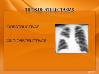 OBSTRUCTIVAS
NO OBSTRUCTIVAS
 