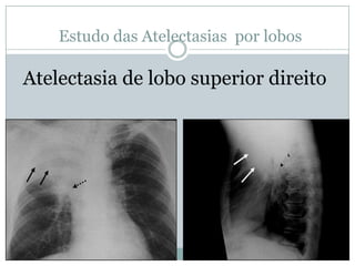 Estudo das Atelectasias por lobosLobo superior direito