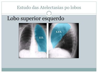 Estudo das Atelectasias  por lobosAtelectasia de lobo superior direito 