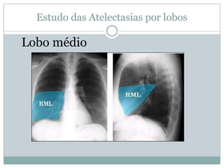 Estudo das Atelectasias por lobosAtelectasiade lobo superior esquerdo