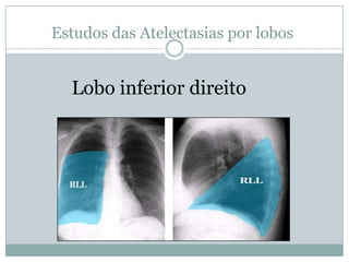 Estudo das Atelectasias por lobos Atelectasia de lobo médio