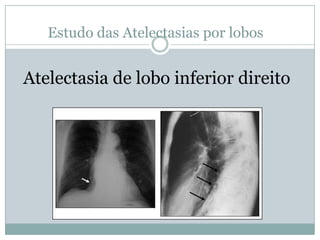Estudos das Atelectasias por lobosLobo inferior direito