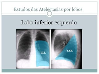 Estudo das Atelectasias por lobosAtelectasia de lobo inferior direito 
