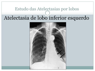 Estudos das Atelectasias por lobosLobo inferior esquerdo