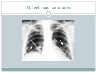 Estudo das Atelectasias por lobosAtelectasia de lobo inferior esquerdo