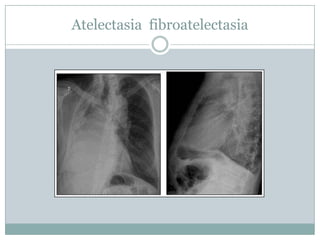 Atelectasias Laminares