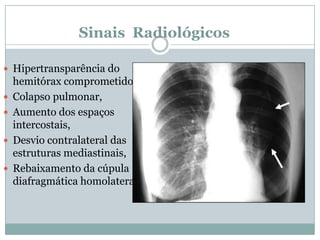 PneumotóraxAvaliação do volume do pneumotórax