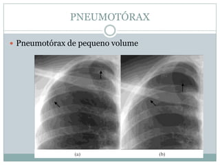 Sinais  RadiológicosHipertransparência do hemitórax comprometido, Colapso pulmonar, Aumento dos espaços intercostais, Desvio contralateral das estruturas mediastinais, Rebaixamento da cúpula diafragmática homolateral