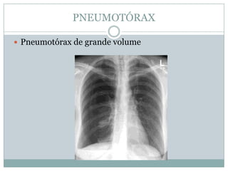 PNEUMOTÓRAXPneumotórax de pequeno volume