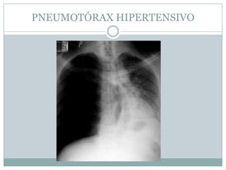PNEUMOTÓRAXPneumotórax de grande volume