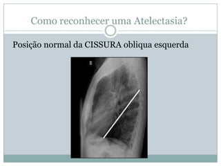 Como reconhecer uma Atelectasia?Posição normal das  CISSURAS. Horizontal e obliqua.