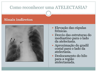 Sinais  diretosDeslocamento das Cisuras   (Quanto maior o colapso maior o deslocamento). Perda da aeração Pulmonar     (Redução da transparência).Aproximação dos vasos pulmonares e brônquios no local atelectasiado.Como reconhecer uma Atelectasia?