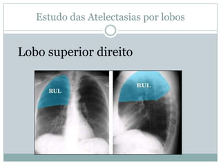 Sinais indiretosElevação das cúpulas frênicas.Desvio das estruturas do mediastino para o lado da atelectasia.Aproximação do gradil costal para o lado da atelectasia.Deslocamento do hilo para a região atelectasiada.Como reconhecer uma ATELECTASIA?