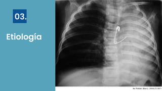 Etiología
03.
 