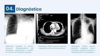 Diagnóstico
04.
Atelectasia completa en pulmón
izquierdo. Desplazamiento del
mediastino, opacificación y pérdida
de volumen en hemitórax izquierdo
Atelectasia, lóbulo superior izquierdo
colapsado con leve derrame pleural
Atelectasia. Lóbulo superior
izquierdo colapsado opaco,
hemitórax izquierdo pequeño, y
desplazamiento del mediastino
 