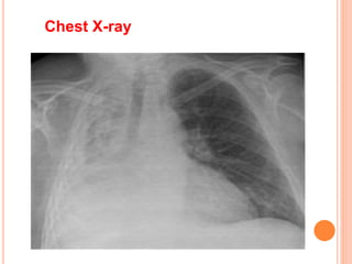 Chest X-ray
 