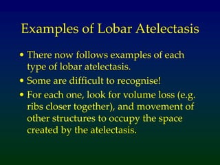 Examples of Lobar Atelectasis
• There now follows examples of each
type of lobar atelectasis.
• Some are difficult to recognise!
• For each one, look for volume loss (e.g.
ribs closer together), and movement of
other structures to occupy the space
created by the atelectasis.
 