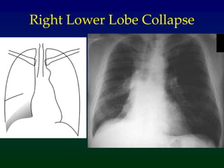 Right Lower Lobe Collapse
 