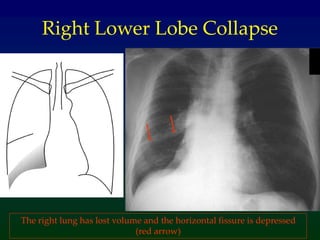 Right Lower Lobe Collapse
The right lung has lost volume and the horizontal fissure is depressed
(red arrow)
 