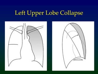 Left Upper Lobe Collapse
 