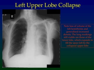 Note loss of volume of the
left hemithorax and
generalised increased
density. The lung markings
still visible are those of the
lower lobe, which expands to
fill the space left by the
collapsed upper lobe
R
Left Upper Lobe Collapse
 
