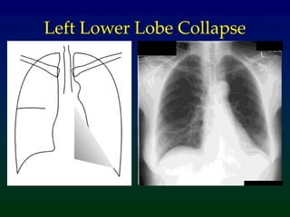 Left Lower Lobe Collapse
 