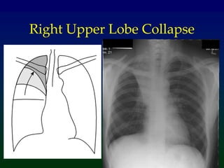 Right Upper Lobe Collapse
 