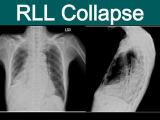 Rml Collapse Radiograph Atelectasis and collapse in CXR | PPTX