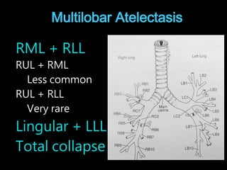 Atelectasis and collapse in CXR | PPTX
