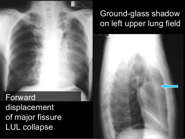 Atelectasis and collapse in CXR