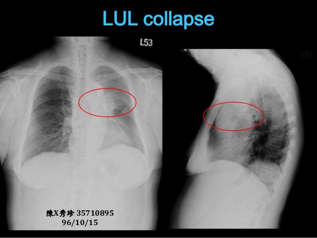 Atelectasis and collapse in CXR