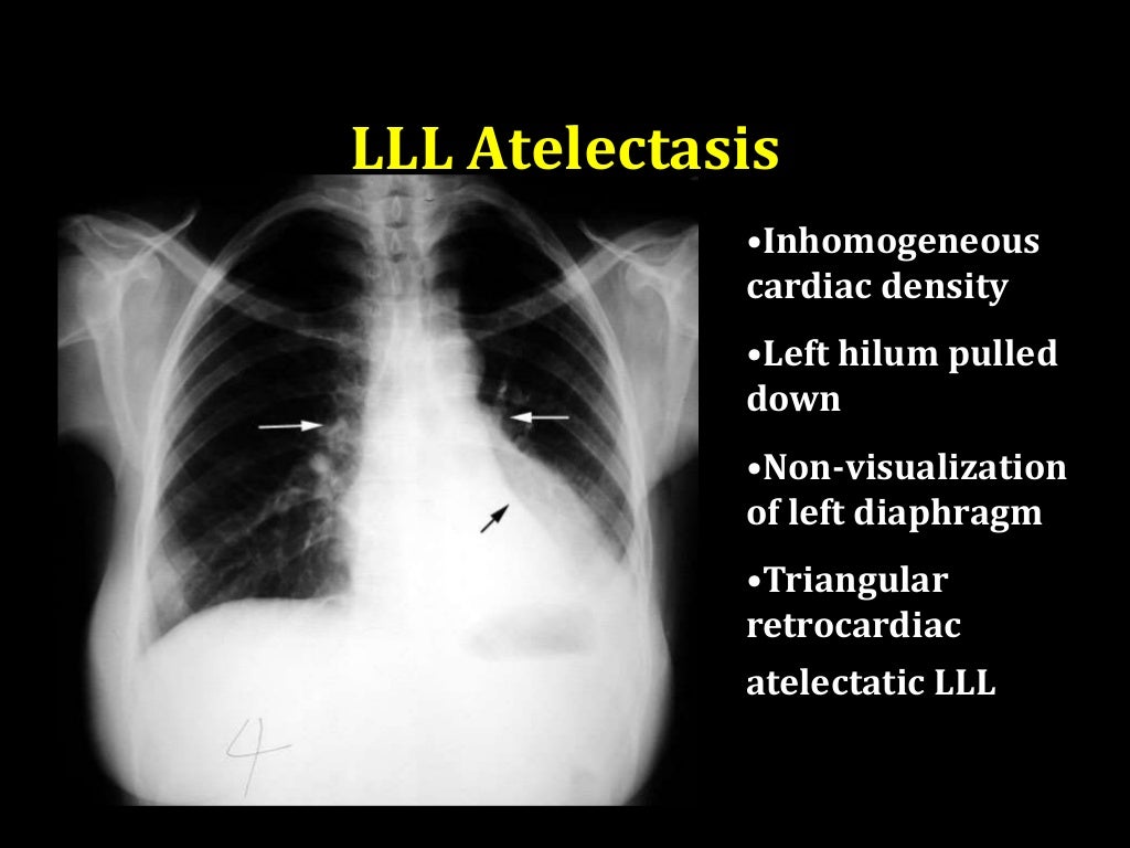 Atelectasis and collapse in CXR
