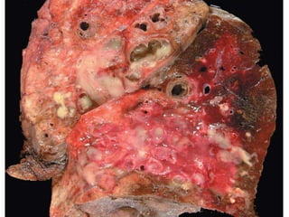 47
Bronchiectasis
47
 