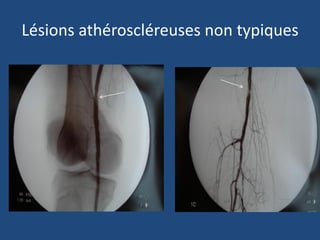 Lésions athéroscléreuses non typiques
 