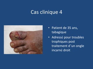 Cas clinique 4
• Patient de 35 ans,
tabagique
• Adressé pour troubles
trophiques post
traitement d’un ongle
incarné droit
 