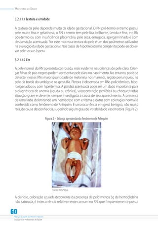 Atenção à Saúde do Recém-Nascido
Guia para os Profissionais de Saúde
60
Ministério da Saúde
3.2.1.1.1 Textura e umidade
A textura da pele depende muito da idade gestacional. O RN pré-termo extremo possui
pele muito fina e gelatinosa, o RN a termo tem pele lisa, brilhante, úmida e fina, e o RN
pós-termo ou com insuficiência placentária, pele seca, enrugada, apergaminhada e com
descamação acentuada. Por esse motivo a textura da pele é um dos parâmetros utilizados
na avaliação da idade gestacional. Nos casos de hipotireoidismo congênito pode-se obser-
var pele seca e áspera.
3.2.1.1.2 Cor
A pele normal do RN apresenta cor rosada, mais evidente nas crianças de pele clara. Crian-
ças filhas de pais negros podem apresentar pele clara no nascimento. No entanto, pode-se
detectar nesses RNs maior quantidade de melanina nos mamilos, região periungueal, na
pele da borda do umbigo e na genitália. Pletora é observada em RNs policitêmicos, hipe-
roxigenados ou com hipertermia. A palidez acentuada pode ser um dado importante para
o diagnóstico de anemia (aguda ou crônica), vasoconstrição periférica ou choque; traduz
situação grave e deve ter sempre investigada a causa de seu aparecimento. A presença
de uma linha delimitando um hemicorpo com eritema e outro com coloração normal é
conhecida como fenômeno de Arlequim. É uma ocorrência em geral benigna, não muito
rara, de causa desconhecida, sugerindo algum grau de instabilidade vasomotora (Figura 2).
Figura2–CriançaapresentandofenômenodeArlequim
Fonte: MS/SAS.
A cianose, coloração azulada decorrente da presença de pelo menos 5g de hemoglobina
não saturada, é intercorrência relativamente comum no RN, que frequentemente possui
 