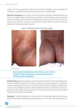 Atenção à Saúde do Recém-Nascido
Guia para os Profissionais de Saúde
62
Ministério da Saúde
costuma ser menor, podendo ser observado em locais protegidos como nas dobras dos
membros e na genitália feminina, entre os pequenos e os grandes lábios.
Manchas mongólicas são manchas azul-acinzentadas localizadas preferencialmente no
dorso e nas regiões glútea e lombossacra, podendo ser disseminadas; traduz imaturidade
da pele na migração dos melanócitos, relacionada a fatores raciais. São mais comuns nas
raças negra e oriental e regridem nos primeiros 4 anos de idade. Essa mancha costuma
despertar o interesse das mães (Figura 4).
Figura4–Apresentaçõesdiversasdemanchamongólica
.
Fonte: MS/SAS.
Deve-se sempre estar atento para não mencionar o nome “mancha
mongólica” devido ao estigma que o termo traz, podendo levar a
constrangimentos desnecessários.
Eritema tóxico geralmente aparece nos primeiros dias de vida sob a forma de lesões erite-
matosas multiformes (pápulas, máculas e até algumas vesículas), esparsas ou confluentes.
O exame microscópico da secreção contida nas lesões mostra migração eosinofílica. Pos-
sui causa desconhecida e pode ser desencadeado por estímulos mecânicos de atrito ou
pressão na pele. Regride espontaneamente, muitas vezes em poucas horas. Tem aspecto
facilmente confundível com impetigo.
Impetigo é a infecção piogênica, mais comumente causada por Staphylococcus aureus.
Inicia-se com lesões eritematosas puntiformes que em um ou dois dias evoluem para ve-
 