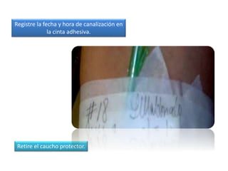 Registre la fecha y hora de canalización en
la cinta adhesiva.
Retire el caucho protector.
 